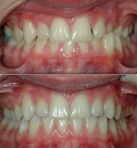 Dane's teeth before and after Invisalign treatment
