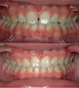 Teen's teeth before and after Invisalign treatment in Kennewick